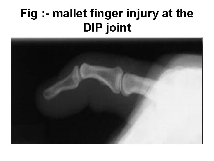Fig : - mallet finger injury at the DIP joint 