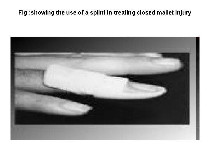 Fig : showing the use of a splint in treating closed mallet injury 