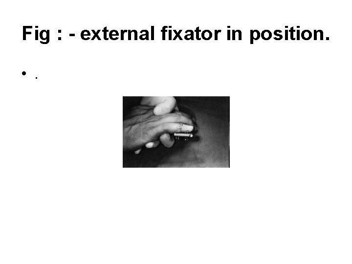Fig : - external fixator in position. • . 