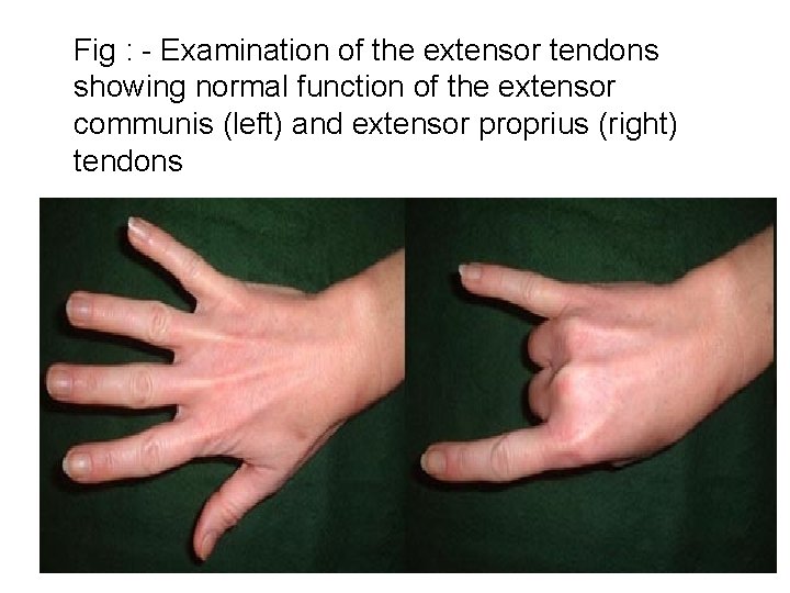 Fig : - Examination of the extensor tendons showing normal function of the extensor