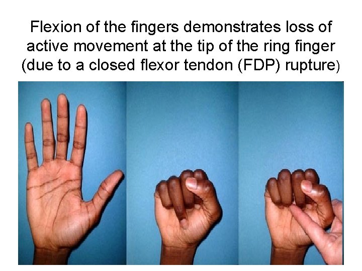 Flexion of the fingers demonstrates loss of active movement at the tip of the