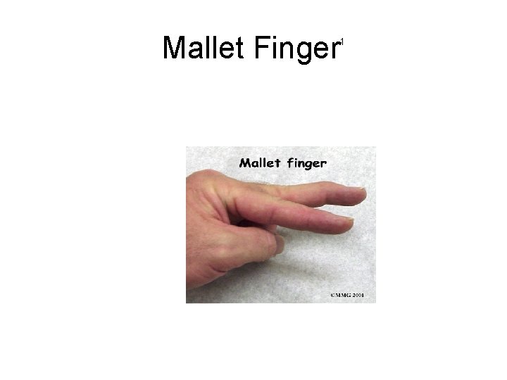 Mallet Finger 1 