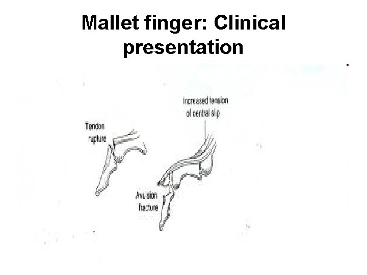 Mallet finger: Clinical presentation 