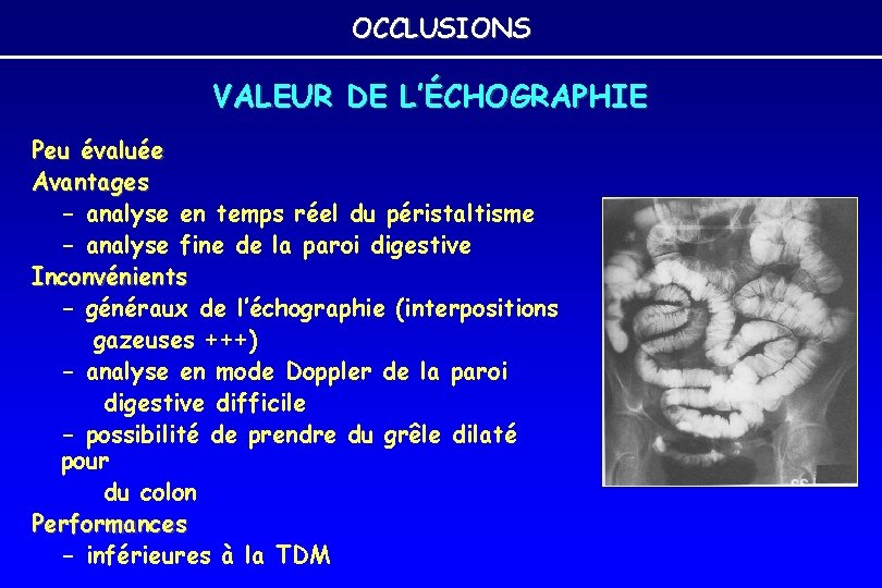 OCCLUSIONS VALEUR DE L’ÉCHOGRAPHIE Peu évaluée Avantages - analyse en temps réel du péristaltisme OCCLUSIONS VALEUR DE L’ÉCHOGRAPHIE Peu évaluée Avantages - analyse en temps réel du péristaltisme