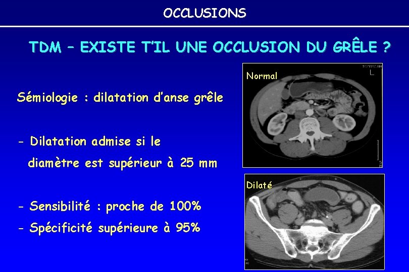 OCCLUSIONS TDM – EXISTE T’IL UNE OCCLUSION DU GRÊLE ? Normal Sémiologie : dilatation OCCLUSIONS TDM – EXISTE T’IL UNE OCCLUSION DU GRÊLE ? Normal Sémiologie : dilatation