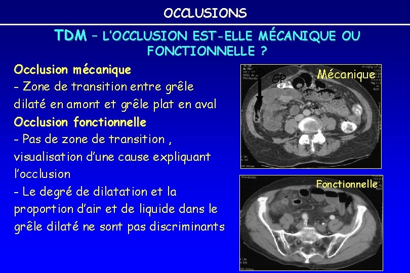 OCCLUSIONS TDM – L’OCCLUSION EST-ELLE MÉCANIQUE OU FONCTIONNELLE ? Occlusion mécanique - Zone de OCCLUSIONS TDM – L’OCCLUSION EST-ELLE MÉCANIQUE OU FONCTIONNELLE ? Occlusion mécanique - Zone de