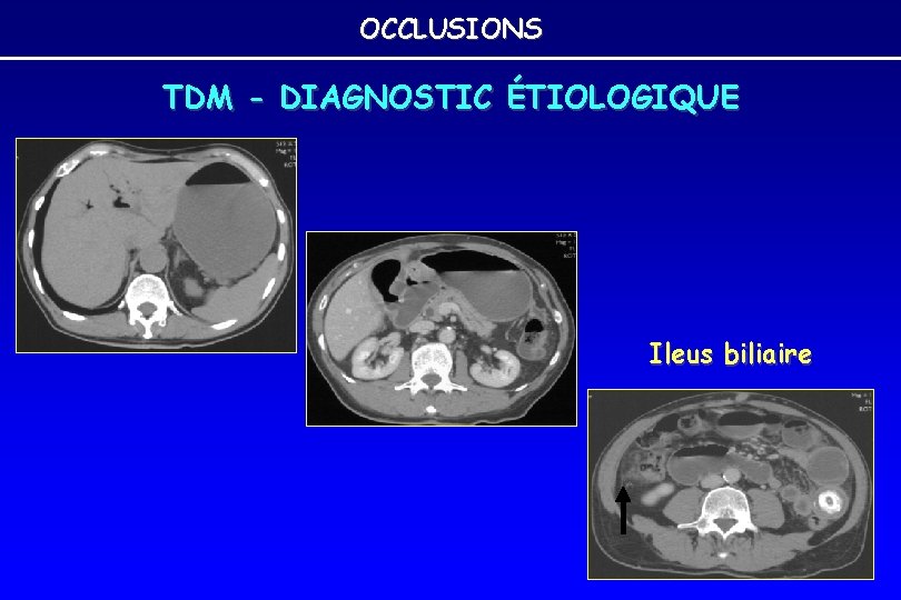 OCCLUSIONS TDM - DIAGNOSTIC ÉTIOLOGIQUE Ileus biliaire OCCLUSIONS TDM - DIAGNOSTIC ÉTIOLOGIQUE Ileus biliaire