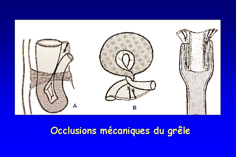 Occlusions mécaniques du grêle Occlusions mécaniques du grêle