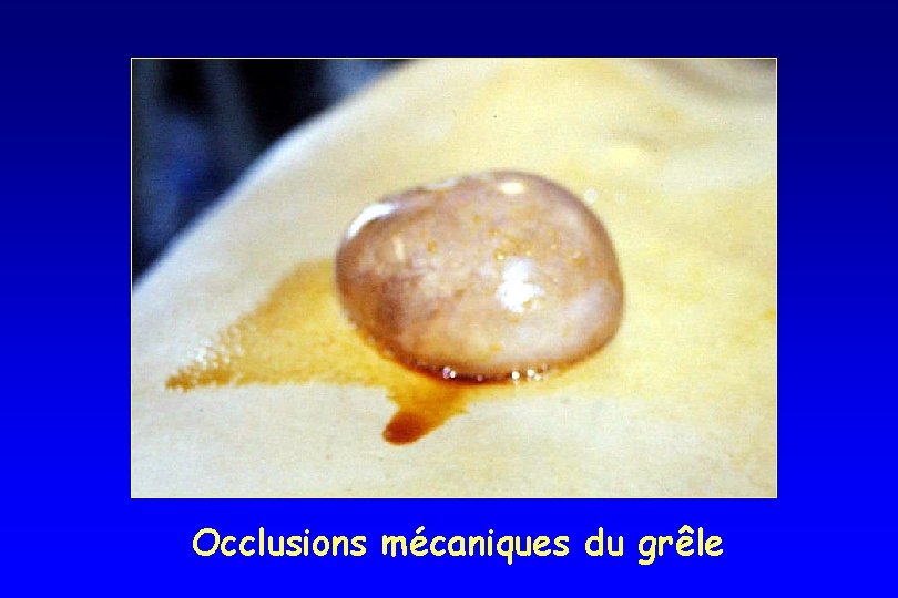 Occlusions mécaniques du grêle Occlusions mécaniques du grêle