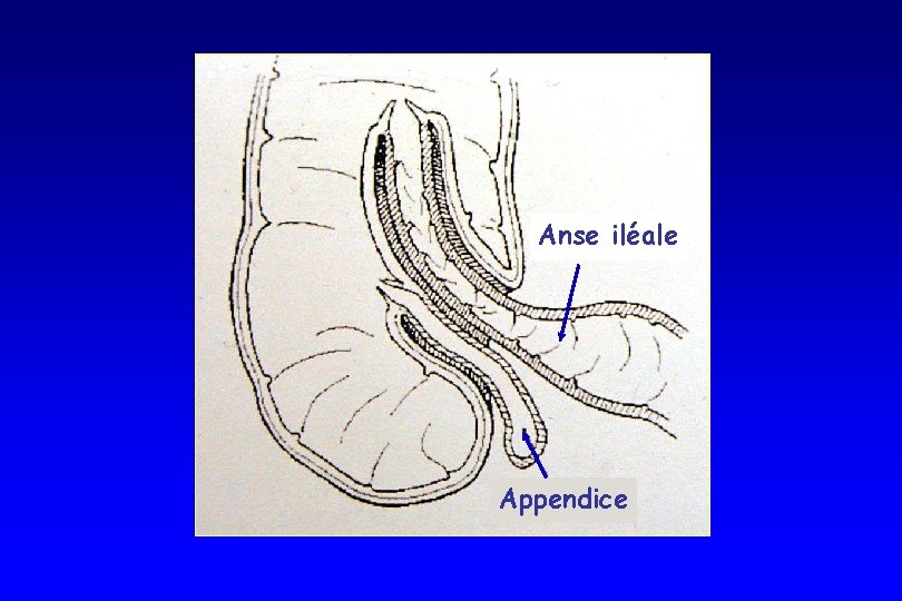 Anse iléale Appendice Anse iléale Appendice