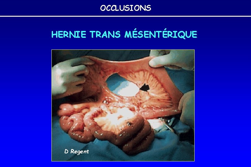 OCCLUSIONS HERNIE TRANS MÉSENTÉRIQUE D Regent OCCLUSIONS HERNIE TRANS MÉSENTÉRIQUE D Regent