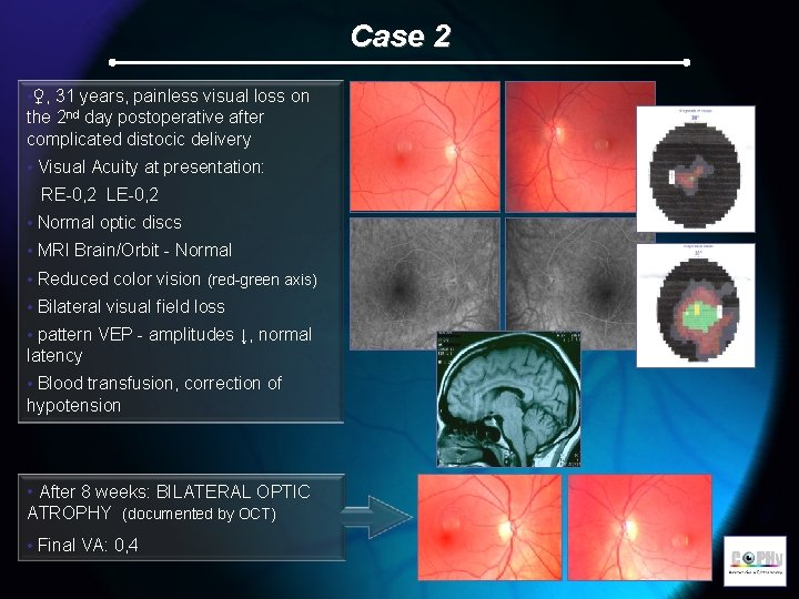 Case 2 • ♀, 31 years, painless visual loss on the 2 nd day