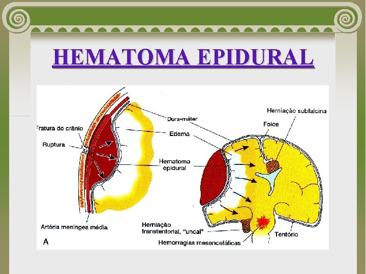 HEMATOMA EPIDURAL 
