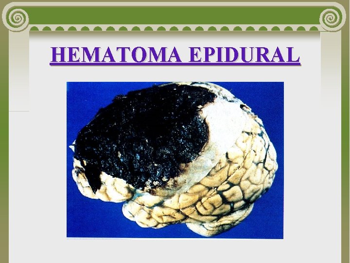 HEMATOMA EPIDURAL 