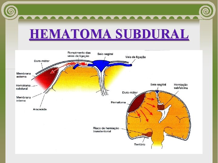HEMATOMA SUBDURAL 