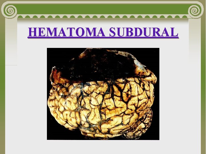 HEMATOMA SUBDURAL 