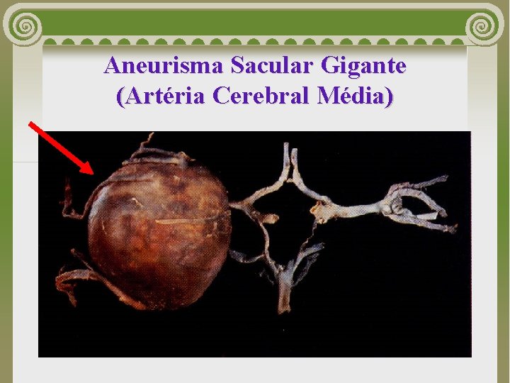 Aneurisma Sacular Gigante (Artéria Cerebral Média) 