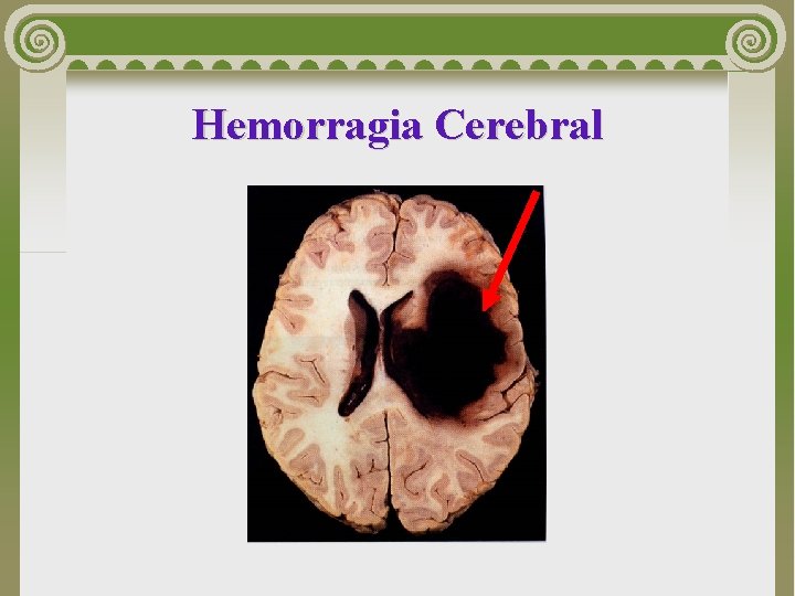 Hemorragia Cerebral 