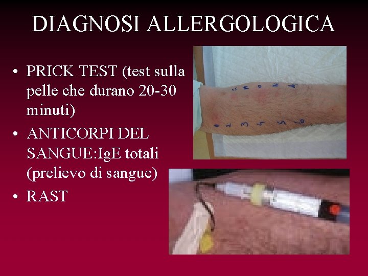 DIAGNOSI ALLERGOLOGICA • PRICK TEST (test sulla pelle che durano 20 -30 minuti) •