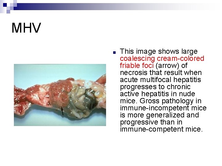 MHV ■ This image shows large coalescing cream colored friable foci (arrow) of necrosis