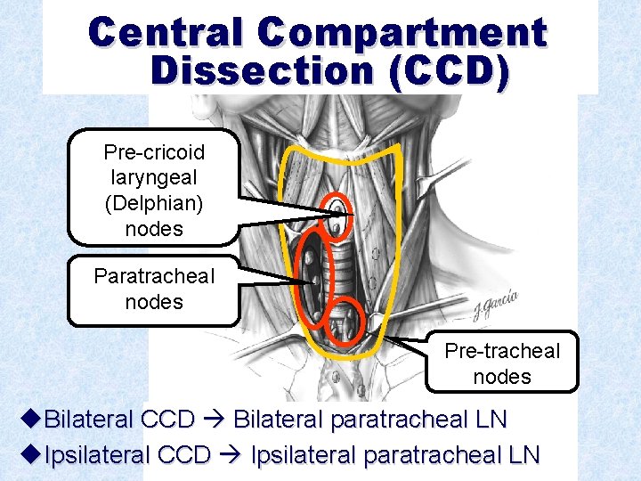 Central Compartment Dissection (CCD) Pre-cricoid laryngeal (Delphian) nodes Paratracheal nodes Pre-tracheal nodes u. Bilateral