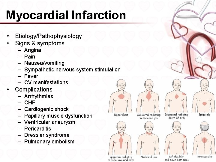 Myocardial Infarction • Etiology/Pathophysiology • Signs & symptoms – – – Angina Pain Nausea/vomiting