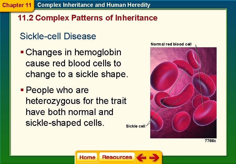 Chapter 11 Complex Inheritance and Human Heredity 11. 2 Complex Patterns of Inheritance Sickle-cell Chapter 11 Complex Inheritance and Human Heredity 11. 2 Complex Patterns of Inheritance Sickle-cell