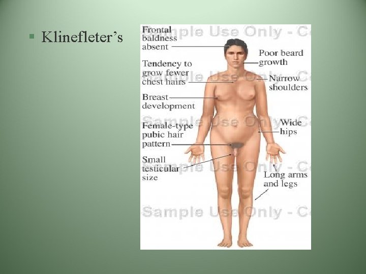 § Klinefleter’s § Klinefleter’s