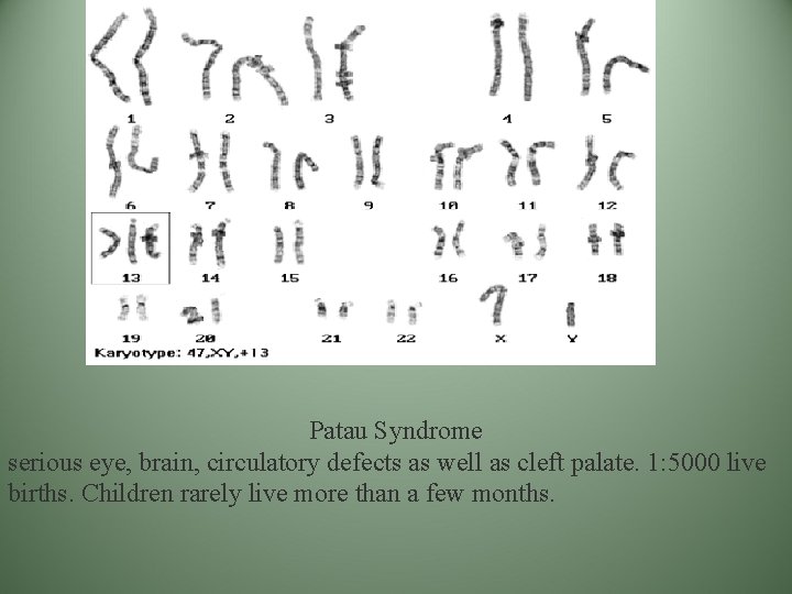 Patau Syndrome serious eye, brain, circulatory defects as well as cleft palate. 1: 5000 Patau Syndrome serious eye, brain, circulatory defects as well as cleft palate. 1: 5000