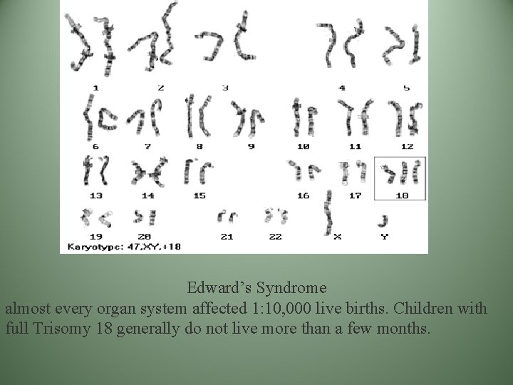 Edward’s Syndrome almost every organ system affected 1: 10, 000 live births. Children with Edward’s Syndrome almost every organ system affected 1: 10, 000 live births. Children with