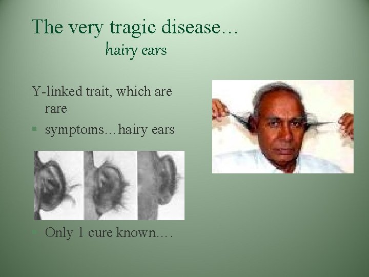 The very tragic disease… hairy ears Y-linked trait, which are rare § symptoms…hairy ears