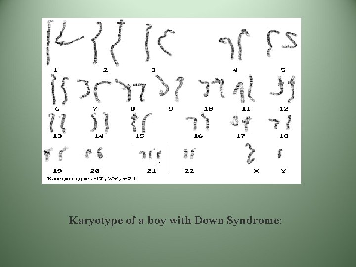 Karyotype of a boy with Down Syndrome: Karyotype of a boy with Down Syndrome: