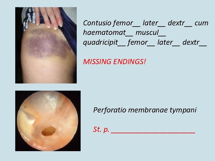 Contusio femor__ later__ dextr__ cum haematomat__ muscul__ quadricipit__ femor__ later__ dextr__ MISSING ENDINGS! Perforatio