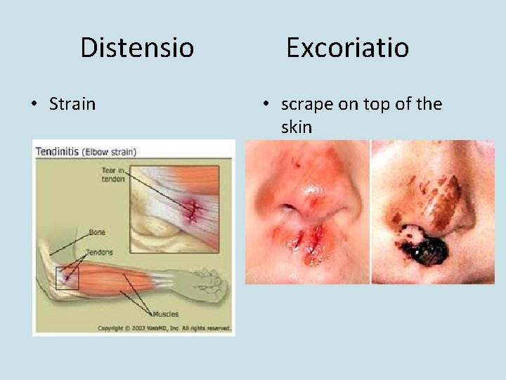 Distensio • Strain Excoriatio • scrape on top of the skin 