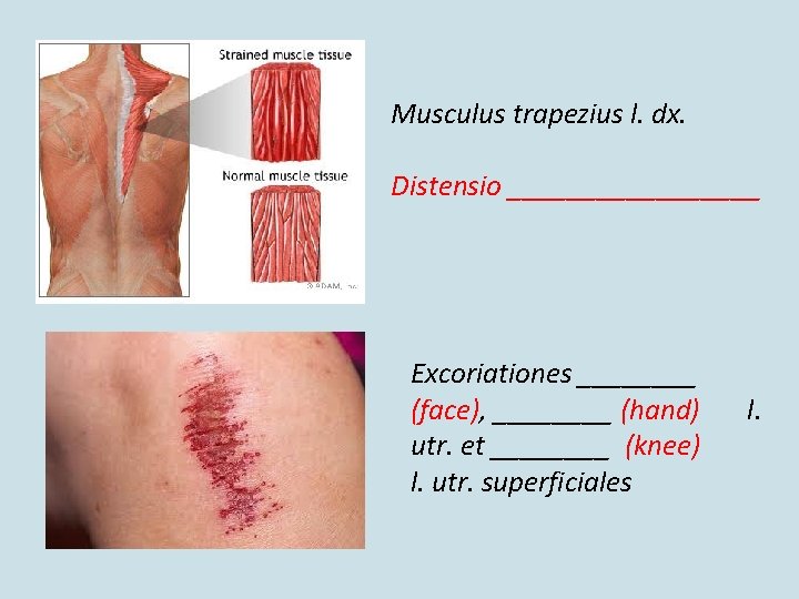 Musculus trapezius l. dx. Distensio _________ Excoriationes ____ (face), ____ (hand) utr. et ____