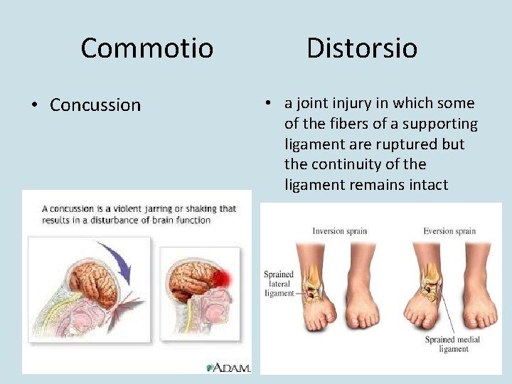 Commotio • Concussion Distorsio • a joint injury in which some of the fibers