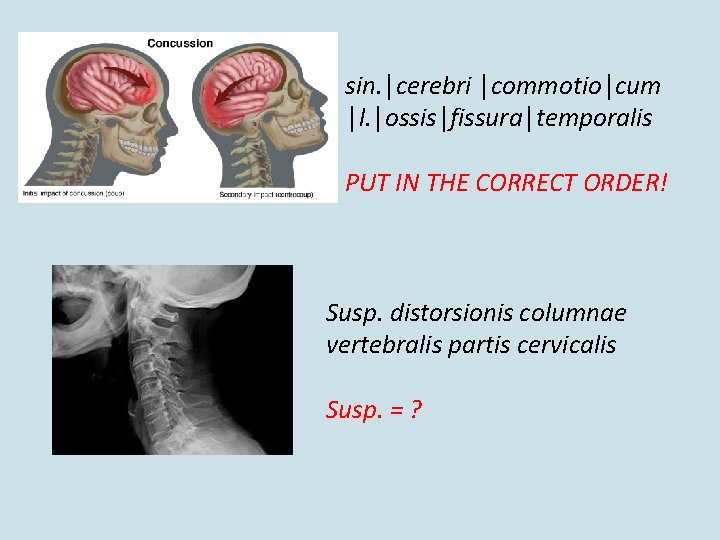sin. │cerebri │commotio│cum │l. │ossis│fissura│temporalis PUT IN THE CORRECT ORDER! Susp. distorsionis columnae vertebralis