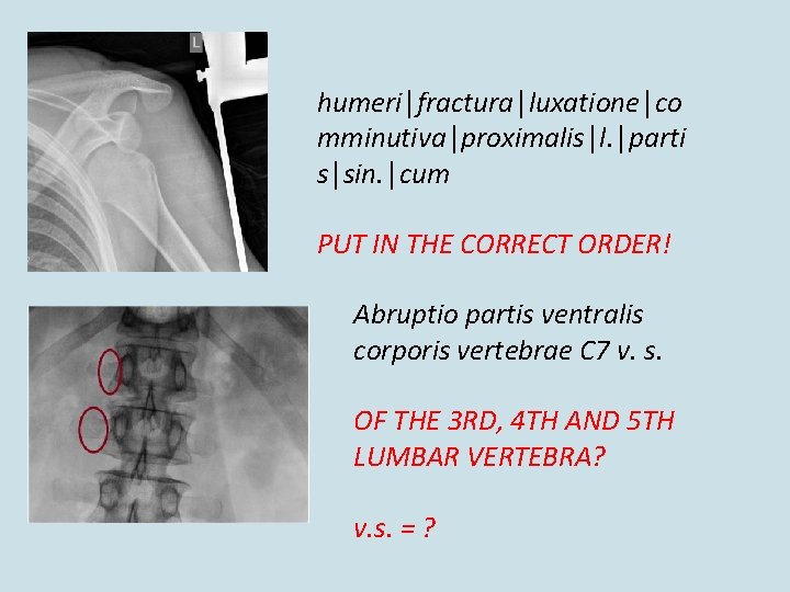 humeri│fractura│luxatione│co mminutiva│proximalis│l. │parti s│sin. │cum PUT IN THE CORRECT ORDER! Abruptio partis ventralis corporis