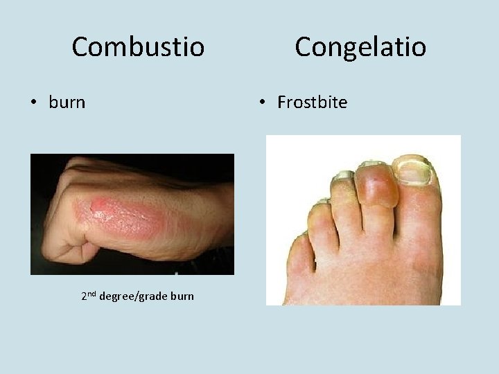 Combustio • burn 2 nd degree/grade burn Congelatio • Frostbite 