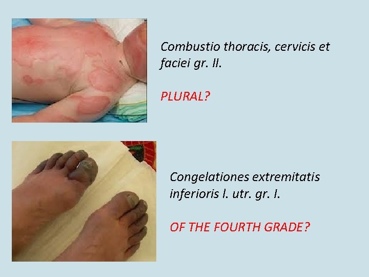 Combustio thoracis, cervicis et faciei gr. II. PLURAL? Congelationes extremitatis inferioris l. utr. gr.