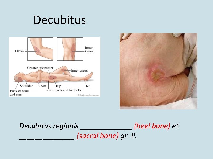 Decubitus regionis _______ (heel bone) et _______ (sacral bone) gr. II. 