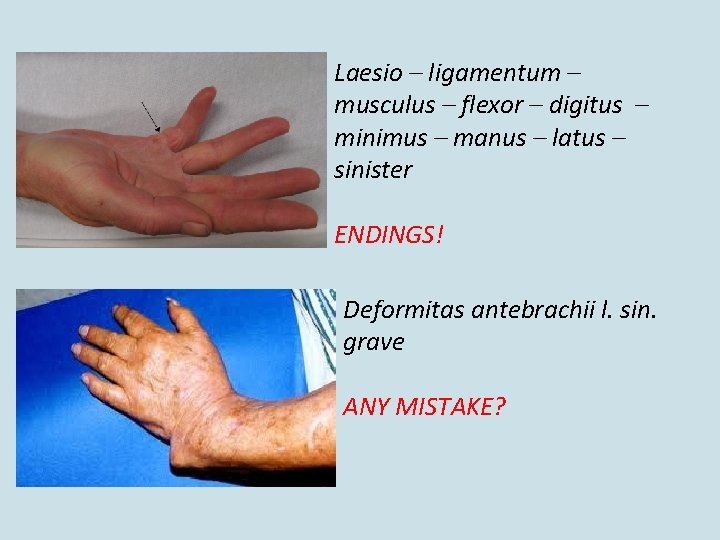 Laesio – ligamentum – musculus – flexor – digitus – minimus – manus –