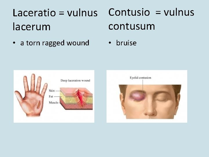 Laceratio = vulnus Contusio = vulnus contusum lacerum • a torn ragged wound •
