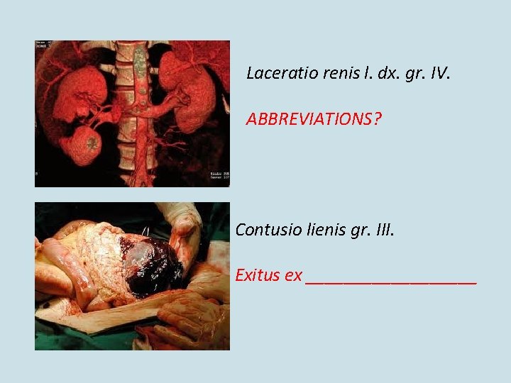 Laceratio renis l. dx. gr. IV. ABBREVIATIONS? Contusio lienis gr. III. Exitus ex _________