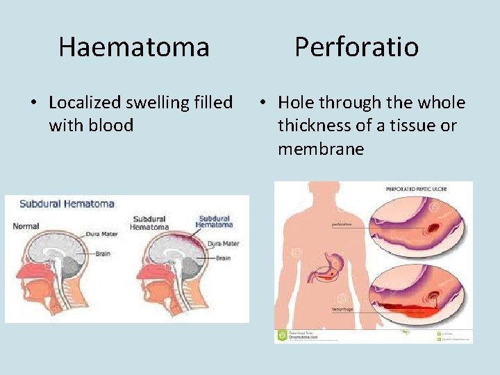 Haematoma Perforatio • Localized swelling filled with blood • Hole through the whole thickness