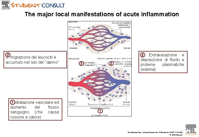 The major local manifestations of acute inflammation 3 3. migrazione dei leucociti e accumulo