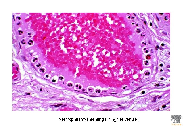 Neutrophil Pavementing (lining the venule) 