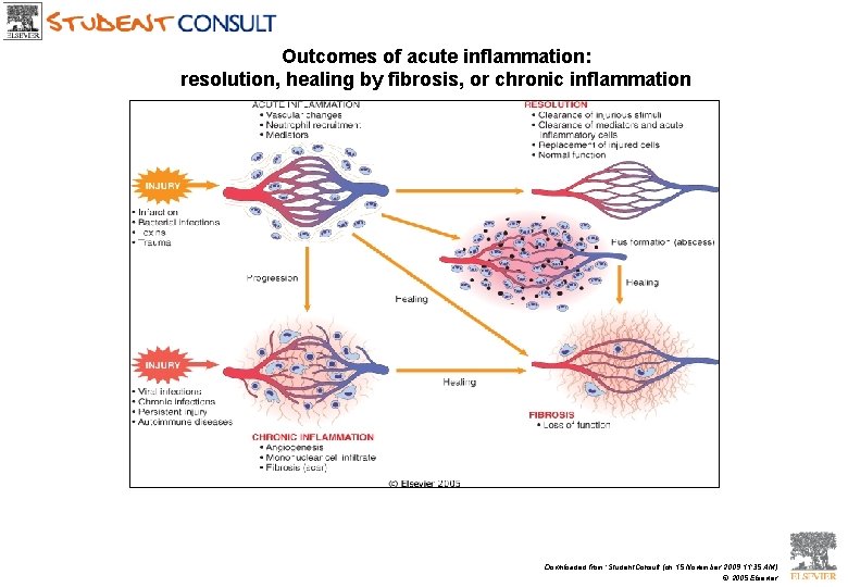 Outcomes of acute inflammation: resolution, healing by fibrosis, or chronic inflammation Downloaded from: Student.