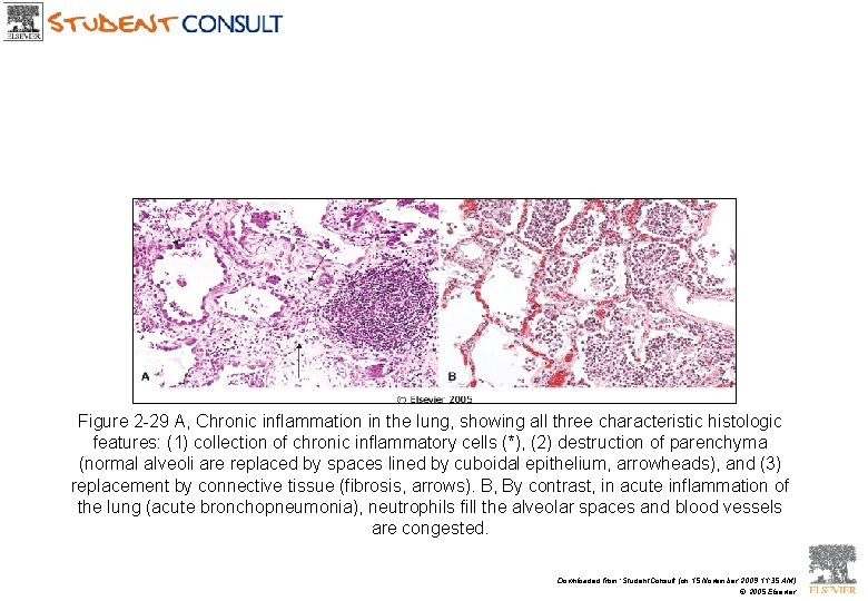 Figure 2 -29 A, Chronic inflammation in the lung, showing all three characteristic histologic