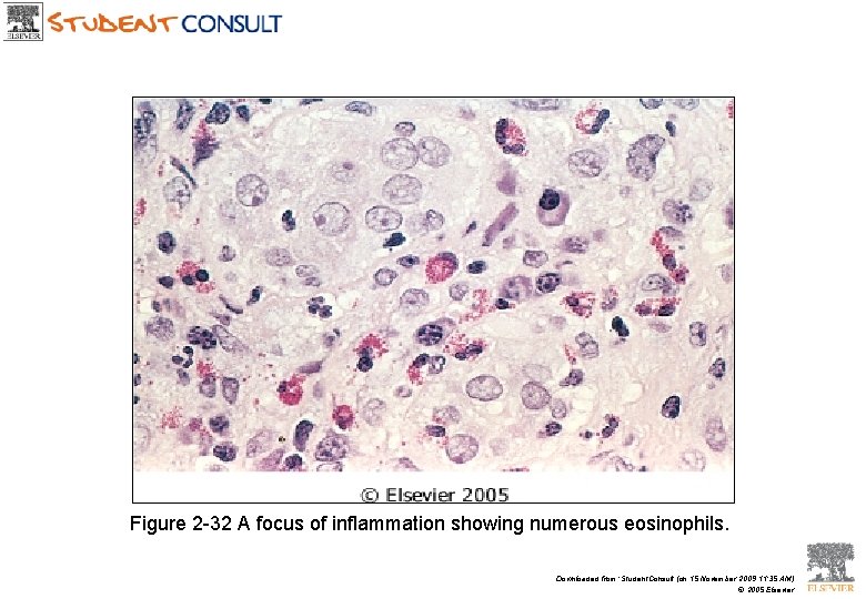 Figure 2 -32 A focus of inflammation showing numerous eosinophils. Downloaded from: Student. Consult